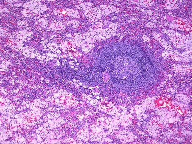 Célula dañada de Niemann-Pick C