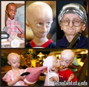 PROGERIA 2